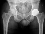 Les pròtesis resurfacing amplien les possibilitats per als pacients actius